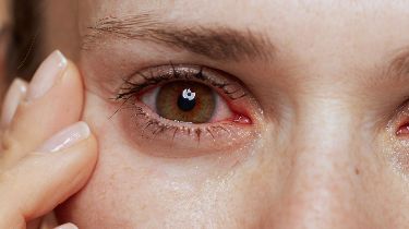 dấu hiệu viêm giác mạc